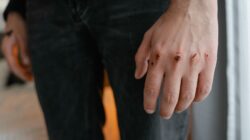 Gambar detail tangan dengan luka dan goresan yang terlihat, menekankan cedera.